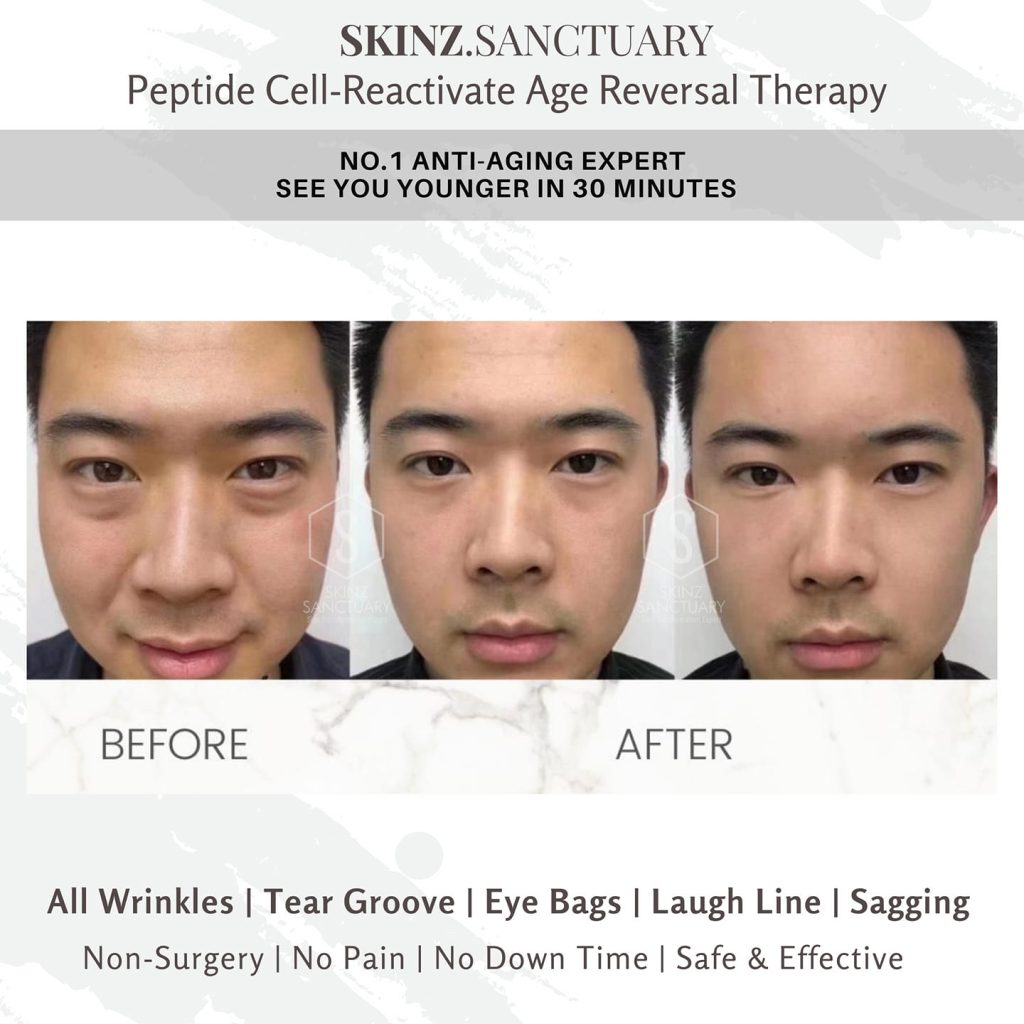 skin tightening treatment